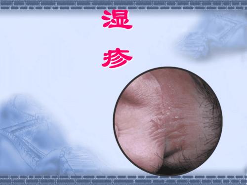 中医治疗湿疹医学ppt课件