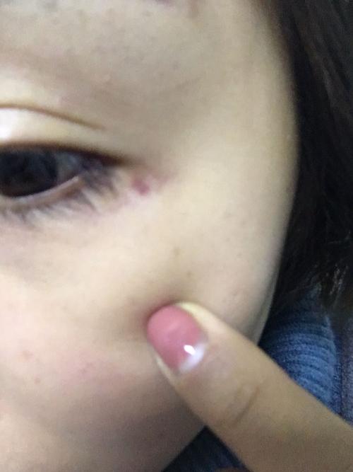 眼尾突然起了个红点不疼不痒