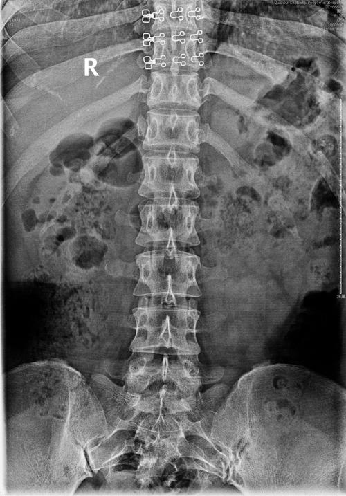 小朱腰椎的正位dr片