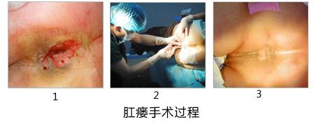 肛瘘术后排便注意哪些问题?怎么治疗效果好呢