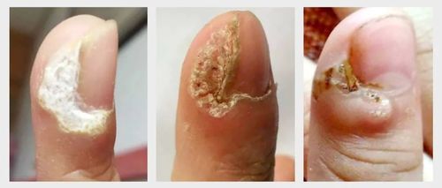 孙叔公干货|540秒,掌握甲周疣核心,节省43%的钱