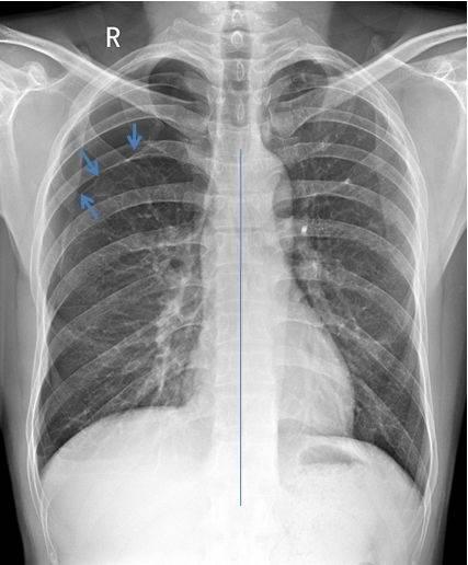 气胸的x线表现,6个病例帮你搞定!