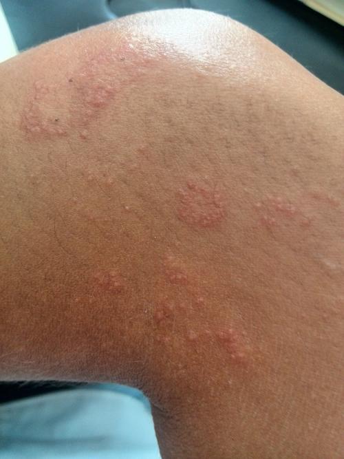 请问这是什么皮肤病啊