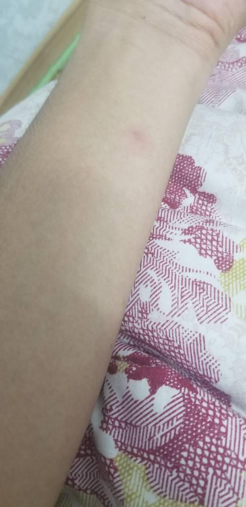 肺结核皮试这样算是正常吗48小时