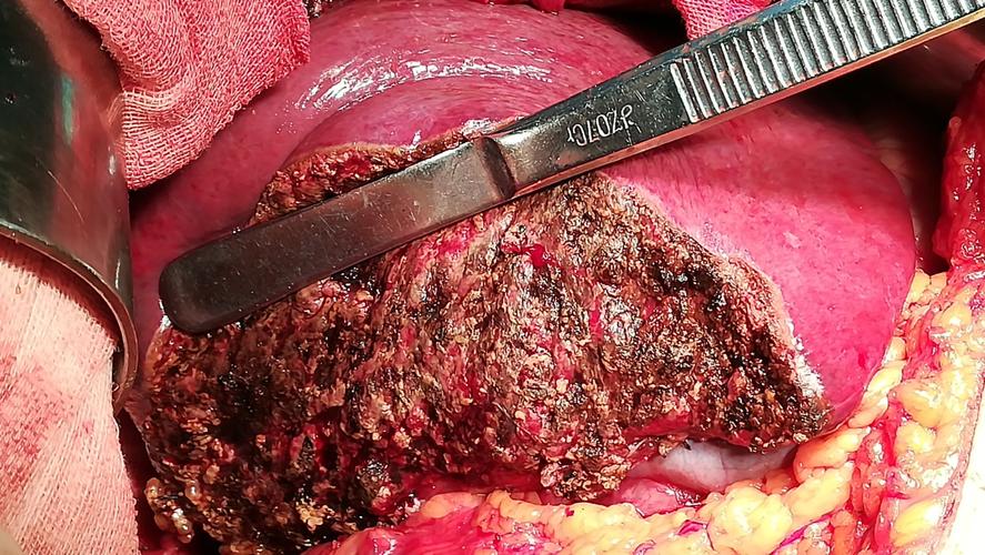 右肝后叶血管瘤切除