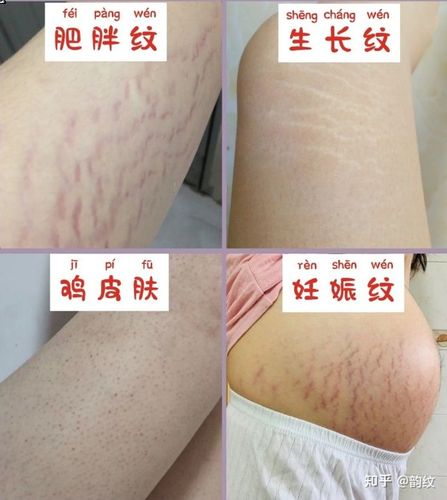 男生能忍受女朋友身上有肥胖纹么?