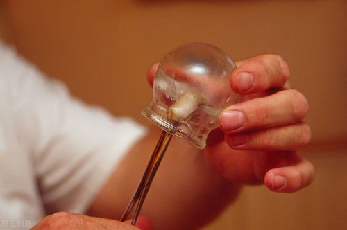 拔罐好处多,可以通络止痛,祛除寒湿,但是不是所有人想拔就能拔