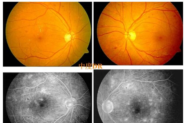 糖尿病视网膜病变有哪些症状,哪些危害?