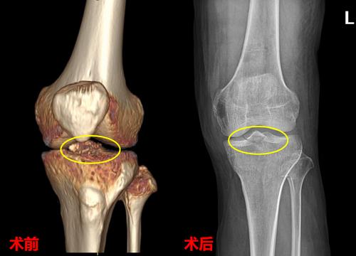 肿胀,活动受限,在外院做膝关节x线检查发现是左侧胫骨髁间棘骨折