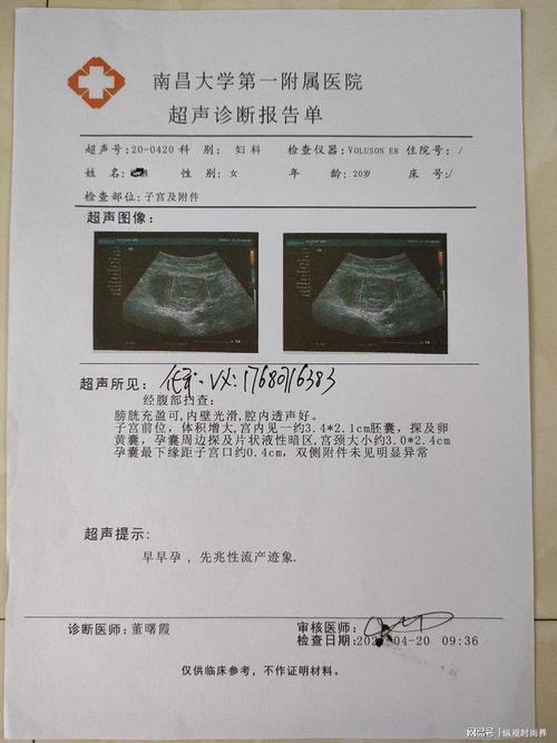 情人亲35天孕囊双胞胎图片怀孕5周加4天b超图怀孕两个