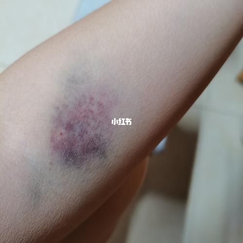 刚开始是发青然后就有点发紫紫青紫青的这几天看起来还有点黄黄的按