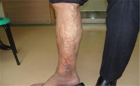 什么是深静脉血栓形成