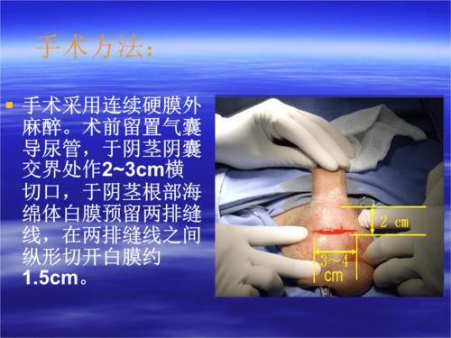 可膨胀型阴茎假体植入术的并发症预防与处理.ppt