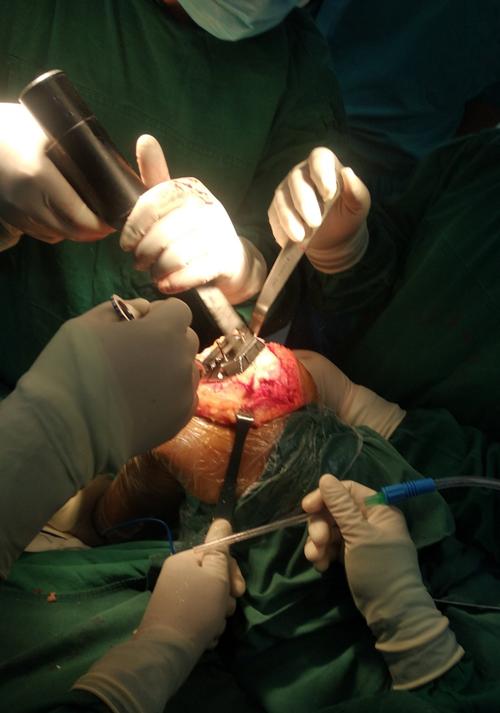 膝关节置换(之十二)