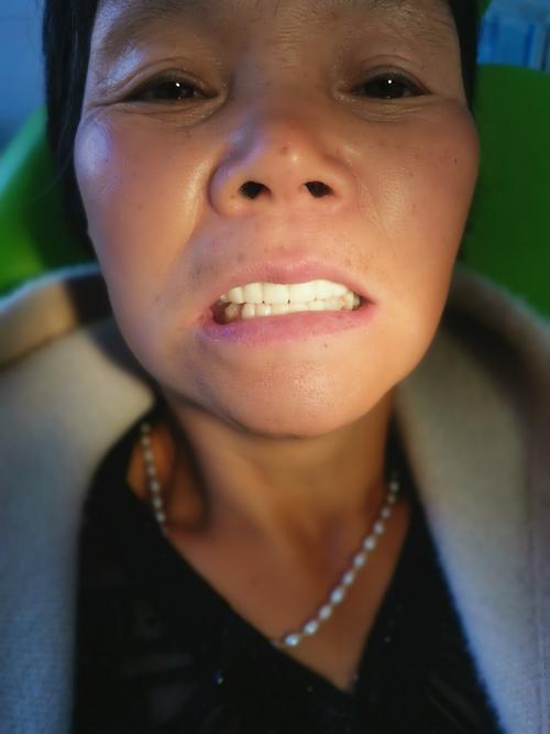 拔牙后!临时性过度全口义齿即可修复.