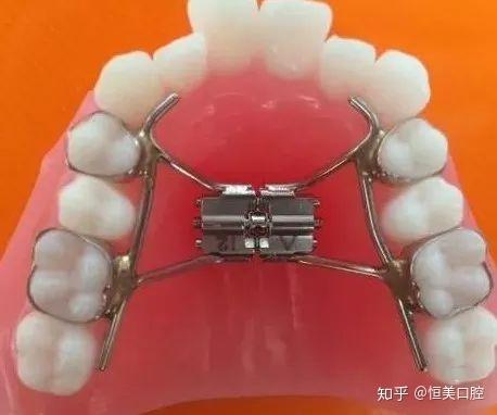 牙齿矫正丨快速扩弓器
