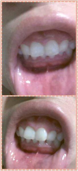 牙齿咬合正常,但咬合时下牙床在上牙床后面好多.下巴短小.