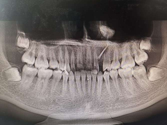 上颌窦底阻生牙拔除