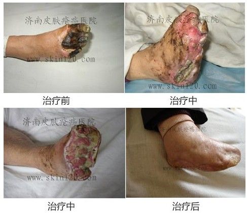 济南市历城区人   右足烫伤不愈3月加重半月来济南皮肤疮疡医院就诊