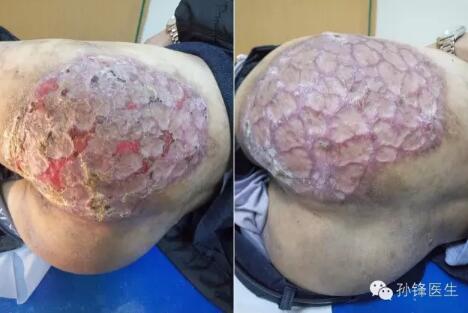 手把手教你做手术:臀部化脓性汗腺炎病灶切除 邮票植皮术