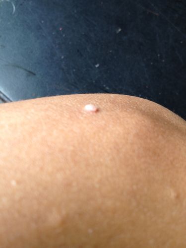 起了个小疙瘩,不痛不痒,很硬的那种,以前阴囊上长了一