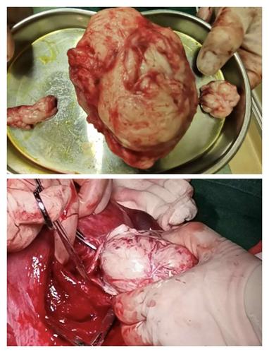 子宫后壁巨大肌瘤,剔除肌瘤切口位于宫腔内.