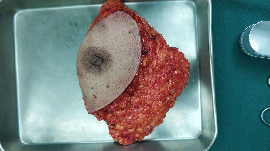 个案分享 重医附一院内分泌乳腺外科—背阔肌带蒂皮瓣
