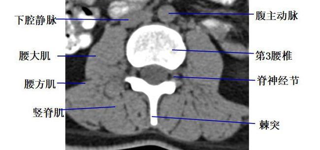 经腰椎椎间盘的横断层面(ct)
