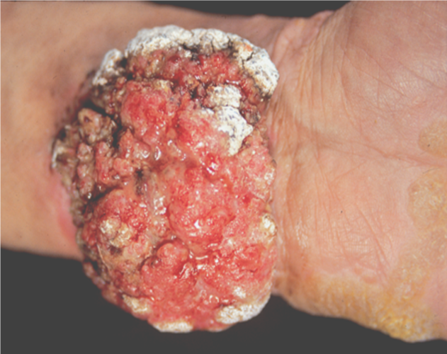 诊断: 鳞状细胞癌的诊断需要依靠皮肤活检病理.