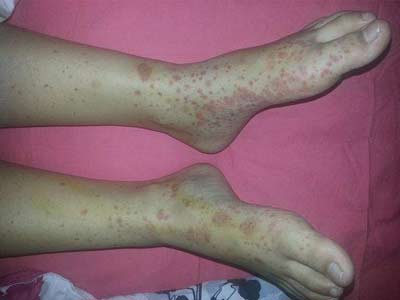 血小板减少性紫癜如何去对待