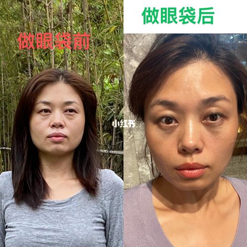 内切眼袋前后对比(38岁)_眼袋_美颜_相机_苹果_无滤镜