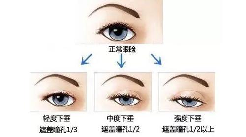 那什么是上睑提肌无力?