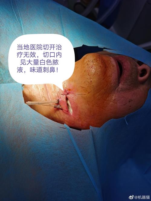 今天下午的任务是三个很严重的颌面颈部多间隙严重感染伴脓肿形成