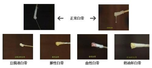 白带异常对女性的危害具体有哪些?_妇科炎症_妇科部_西安曲江妇产医院