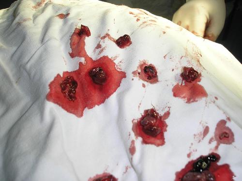 外痔图片_外痔症状表现图片大全_有来医生