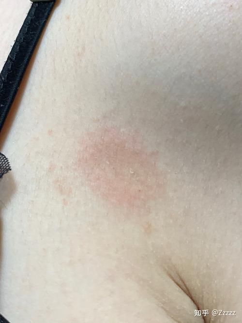 我这个是不是玫瑰糠疹 玫瑰糠疹一定会长全身么?