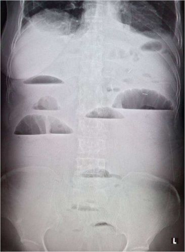 梗阻发生后的4～6小时,腹平片上即可见胀气的肠袢及多数气液平面.