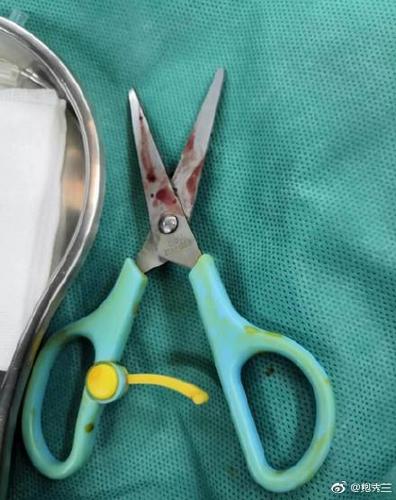 心疼!男童剪刀扎入面部,才2岁大 网友:这妈心可真大