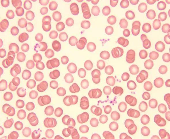 形态学报告中血小板应该如何描述|经验分享