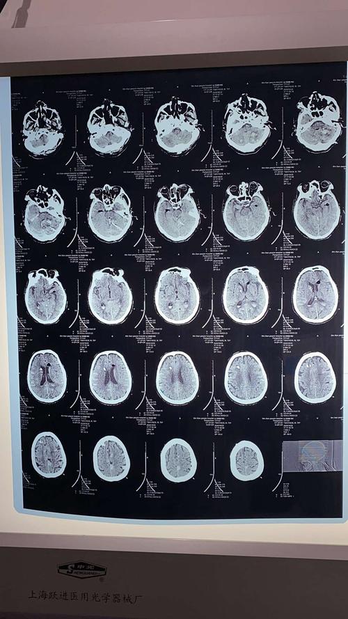 脑出血,我们一直在努力!