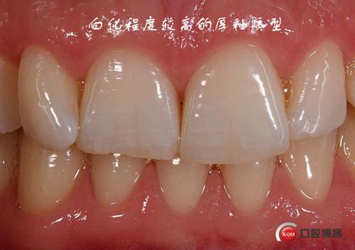 个性和 共性(规律性),对天然牙齿颜色的分析以及修复体颜色 合格标准