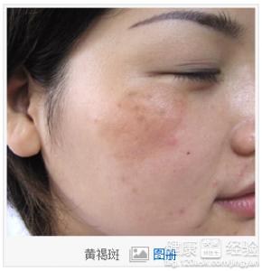 如何治疗黄褐斑