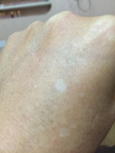 我手上和脸上有些白色的圆点,去皮肤专科检查说是滴状形黑色素减退