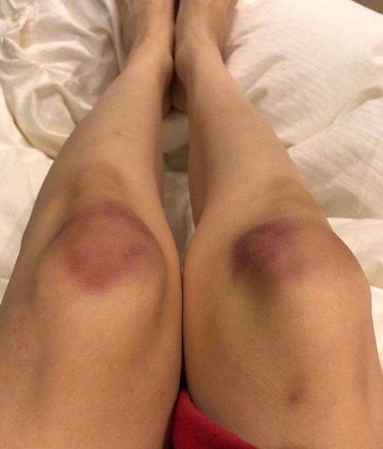 膝盖淤青红肿,网友直呼:为什么受伤的总是你!