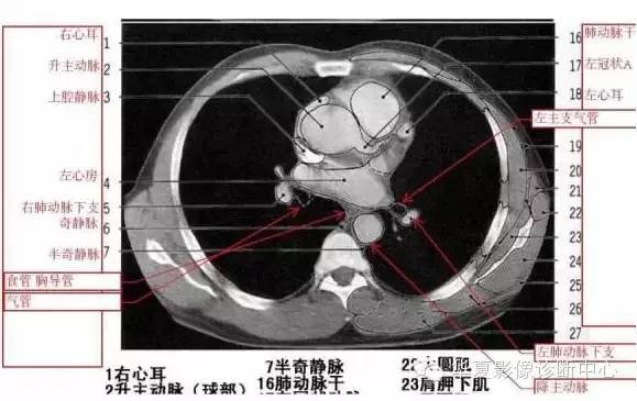 胸部血管  纵隔分区胸部ct影像示意图心室层面左右房室层面左心房层