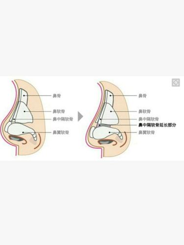 真相取#鼻中隔#,鼻子是不是会塌了呀
