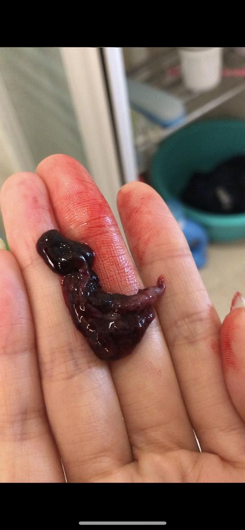 昨晚听医生的话吃了药药流的今天中午特别痛的一阵排出来的这是胚胎吗