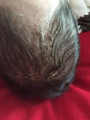 宝宝两个月,头皮上长了如图的东西,是乳痂还是湿疹?怎麼解决?