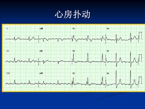 心房扑动,心房扑动怎么办,房扑,房性心动过速,心房颤动,冠心病,急性