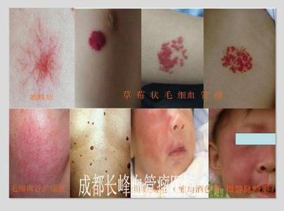 毛细血管瘤初期的图片